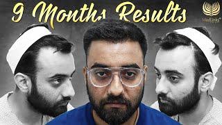 Best Hair Transplant Results in India Grade 2 Baldness Month by Month Before After Results in Delhi