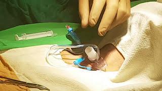 Percutaneous tracheostomy in 2 mins II عملية فتح القصبة الهوائية عن طريق الجلد في دقيقتين