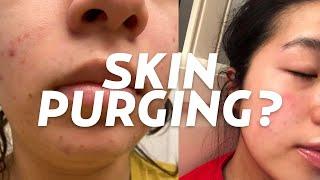 Is Your Skin Purging or Breaking Out? A Dermatologist Discuss this Skincare Concern!