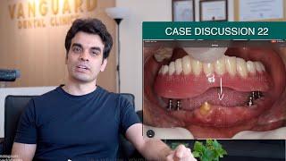 Denture on Implants - Case Discussion 22