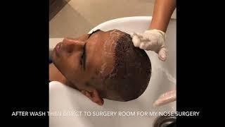 My Nose surgery & hair transplant in Istanbul Turkey / operasi hidung & tanam rambut di Istanbul