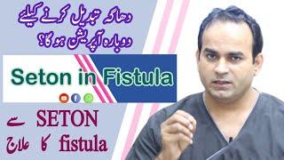 Seton Treatment of Fistula in Ano | Surgeon Dr Imtiaz Hussain