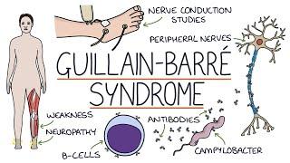 Understanding Guillain-Barré Syndrome