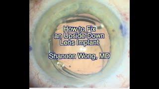 How to fix  the upside-down IOL.  Shannon Wong, MD.  11-4-19