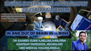 CEREBRAL ANGIOGRAPHY # UNCUT VIDEO OF A REALTIME DSA# NEUROINTERVENTION SERIES 2#DR AHAMED SUBIR