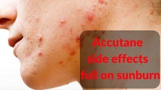 Accutane  side effects- sunburn