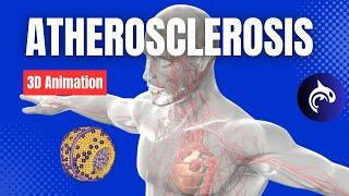 Learn about Atherosclerosis - 3D Animation