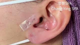 1顆耳朵黑頭&4顆小粉刺｜Blackheads on ear Removal!! (耳の角栓/耳掃除)