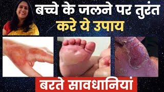 बच्चे के जलने पर तुरंत करें घरेलू उपाय/ What to do in case of burn /Burn treatment at home.