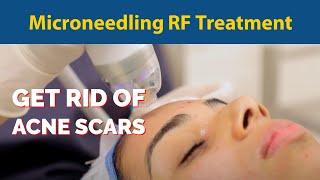 Microneedling RF Treatment for Acne Scars | Get rid of acne scars | Dr. Jyoti Gupta MD