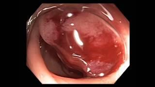 Colonoscopy:  Sigmoid Polyp 1