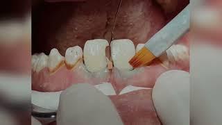 How to remove caries of your teeth and replace with composite restoration