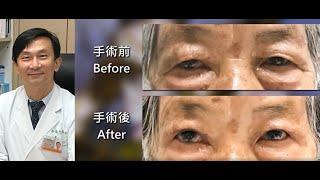 老年性眼皮鬆弛下垂--眼皮美容整形手術Surgery for Dermatochalasis of upper eyelids 新眼光眼科診所