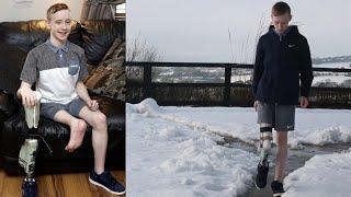 15-Year-Old Gets Foot Re-Attached Backwards After Leg Is Amputated From Cancer