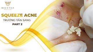 Điều Trị Mụn Ẩn Hiệu Quả, Uy Tín Nhất TPHCM Tại Hiền Vân Spa I Bảo hành trọn đời I 470