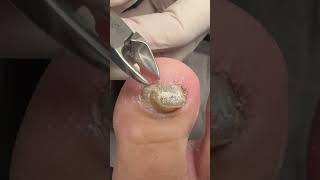 These Nails Point STRAIGHT UP  Thick Toenail Transformation! #nailcutting #nails