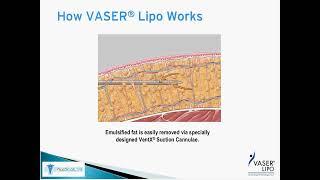 25) vaserlipo video