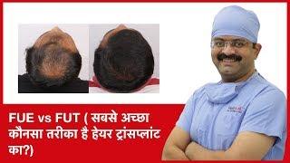 FUE vs FUT: Which one is a best method of hair transplant | HairMD, Pune | (In HINDI)