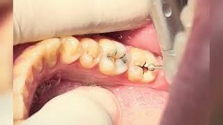 Teeth Composite Restoration After Deep Caries Cleaning