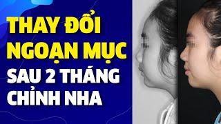 Niềng Răng Thay Đổi Ngoạn Mục Sau 2 Tháng | Nam Bùi Vinalign