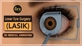 Laser Eye Surgery (LASIK) ~ 3D Medical Animation