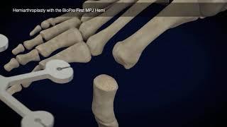 Toe Surgery Animation with First MPJ Hemi Implant
