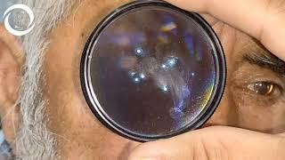 How actual floaters looks inside Eye