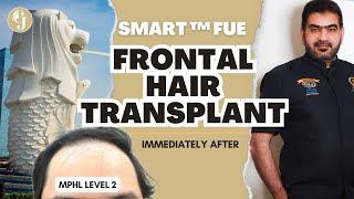 IMMEDIATELY AFTER SMART™ FUE HAIR TRANSPLANT | GLOJAS AESTHETIC CLINIC