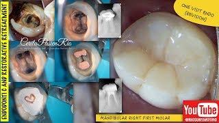 one visit endodontic one curve micro-mega rewalling composite resin perawatan saluran akar