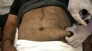 Lipodissolve Injection Technique for Peri-Abdominal Fat - ILAMED