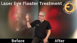 Treating the "Untreatable" VITREOUS EYE FLOATERS with YAG Laser