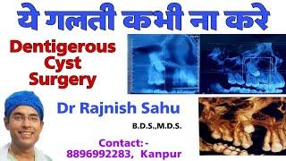 Dentigerous Cyst | A Large Dentigerous Cyst Surgery | @rajnishsahu82