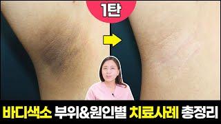 요청) 겨드랑이.팔꿈치,종아리 등바디색소침착 부위별&원인별 치료전후 공개 1탄