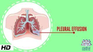 Pleural Effusion, Causes, Signs and Symptoms, Diagnosis and Treatment.