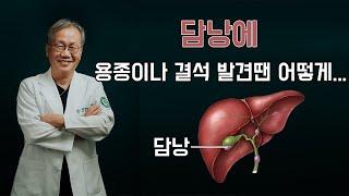 담낭에 용종이나 결석 발견땐? 쓸개 제거해도 사는데 지장없나