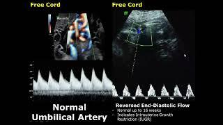 Umbilical Artery Doppler Ultrasound Normal Vs Abnormal Image Appearances | Spectral Doppler USG