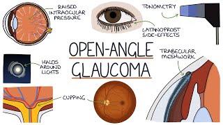 Understanding Open Angle Glaucoma