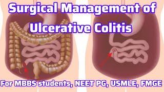 Surgical management of IBD For MBBS students, Neet PG, Usmle, FMGE I Neet PG Usmle Preparation