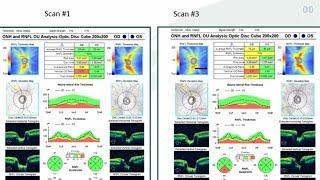 10 Hacks for OCT Interpretation in Glaucoma - Dr. Mark Dunbar