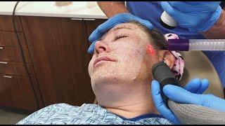 Full Face Fractional CO2 Laser Resurfacing for Wrinkles and Skin Tightening