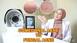 COMEDONAL ACNE VS FUNGAL ACNE!!