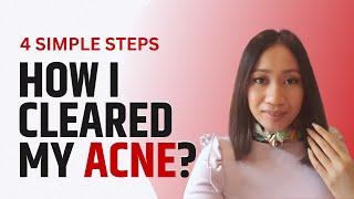 How I Cleared My Hormonal Acne with 4 Simple Beauty Regimen? Cells and Skin Activation!