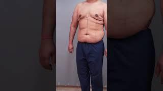 360° Abdomen Liposuction | Male Abdomen Liposuction result