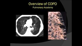 Pulmonary Academy - Overview of COPD