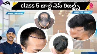 Hair Transplant In Hyderabad | Best Cost Surgeon & Results Of Hair Transplant Surgery In Hyderabad