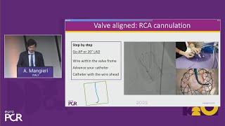 Future-proof your TAVI programme: increased need to enhance pathway efficiencies - EuroPCR 2025