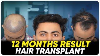 Hair Transplant in Bangalore | Best Results & Cost of Hair Transplant in Bangalore