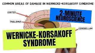 2-Minute Neuroscience: Wernicke-Korsakoff Syndrome