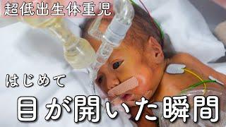 【23週で生まれた双子】はじめて目が開いた瞬間が尊い【超低出生体重児】