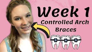 Controlled Arch Braces | Week 1 | Personal Update